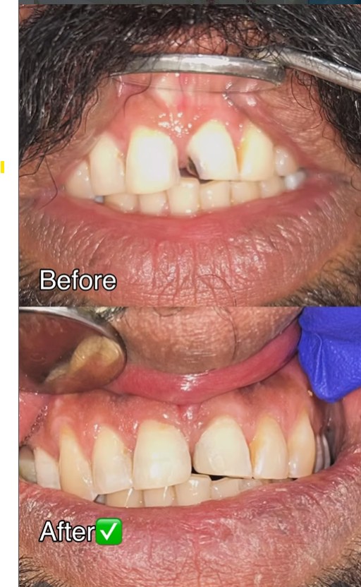 Smile Transformation